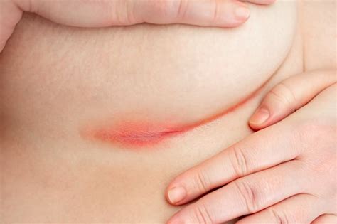 incontinence  dermatitis introduction  assessment