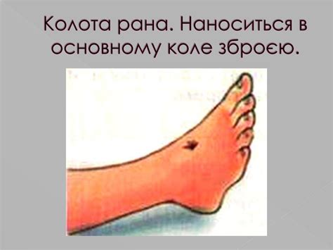 Рани. Характеристика ран. Перша допомога при поранені - презентация онлайн