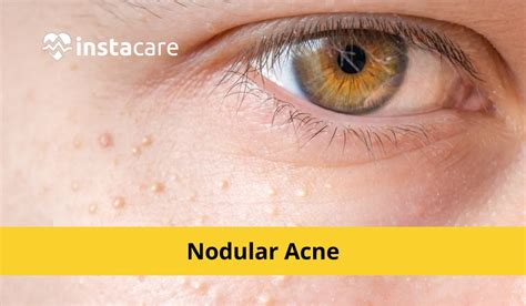 Nodular Acne: Causes, Symptoms, Treatment and More