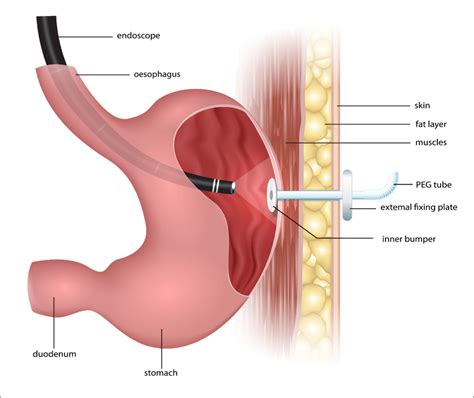 Enteral Feeding and Colostomy Care Continuing Education Courses in New ...