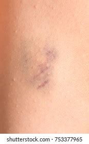 injuries impact exposure bruises broken blood stock photo