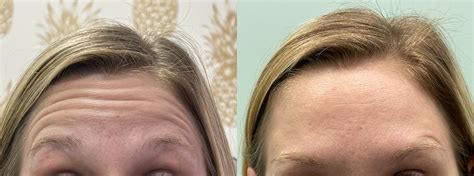 Botox, Patient 1 - LIV Wellness Lounge, Inc