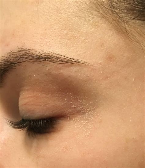 [misc] Recommendations for dry flaky skin around eyes Flaky Skin On ...