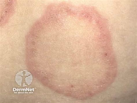 Erythema annulare centrifugum