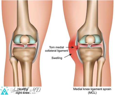 Medial knee ligament sprain medical vector illustration isolated on ...