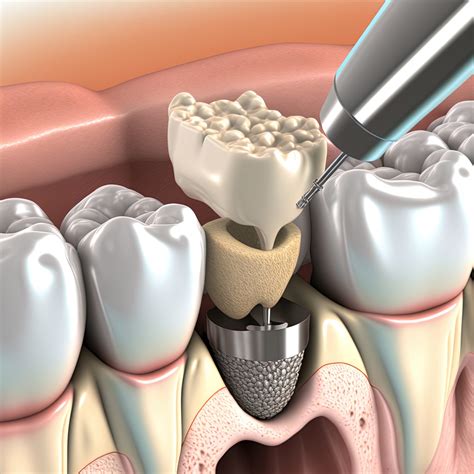 RidgeAugmentation With Laser Dentistry | Encinitas, CA