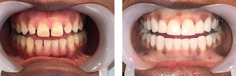 Microdontia: Causes And Treatments | Longevita