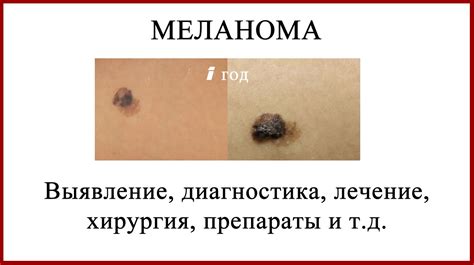 Меланома Лечение Личный Опыт.