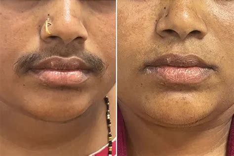 laser hair removal permanent facial hair removal