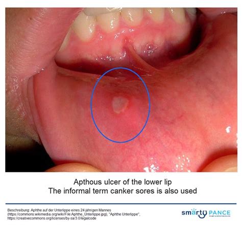 sore lipouth ulcers infoupdateorg