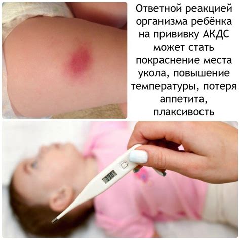 Проба (прививка) манту: для чего её делают и на какой день проверяют?