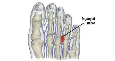 Morton's Neuroma - Symptoms, Causes, Treatment and Exercises