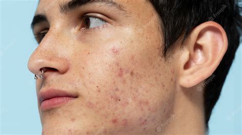 Pimple Wallpapers - Top Free Pimple Backgrounds - WallpaperAccess
