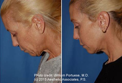 Dermabrasion Photo Gallery - Before and Afters