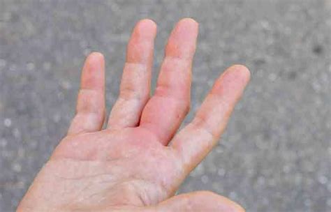 Degenerative Arthritis In Finger Joints