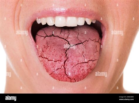 Woman Mouth And Broken Tongue With Cracks Stock Photo - Alamy