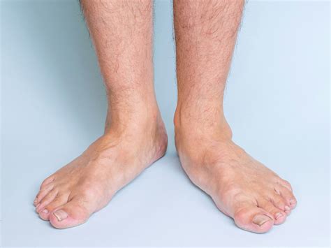 how to tell if you have flat feet 7