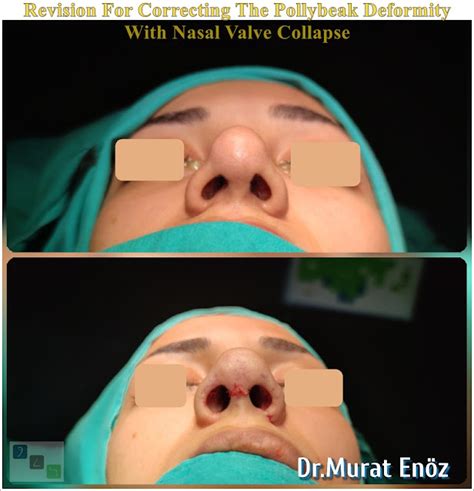 We Performed Revision Nose Surgery For Correcting the Pollybeak ...