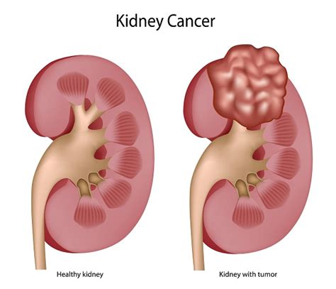 Kidney Tumor Ultrasound