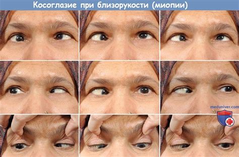Косоглазие от близорукости (эзотропия) - причины, диагносотика, лечение