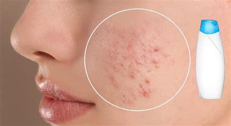 dermatologist approved hack  treat fungal acne  head shoulders