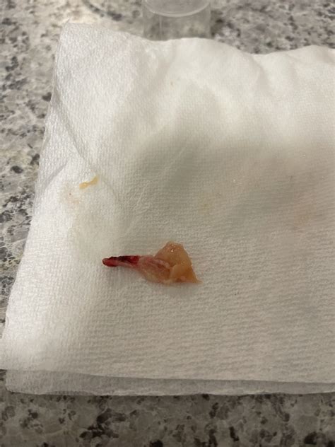 Fighting off a flu / cold, blew this nasal polyp out. I suspected I