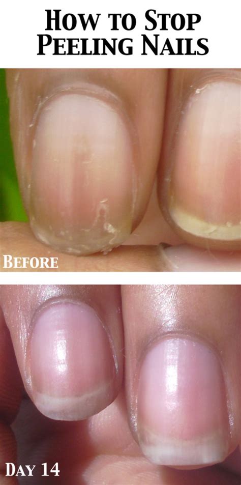 Peeling-Nails-Solution-Close-Up - Nail Care HQ