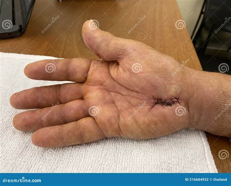 Man`s Swollen Hand. Carpal Tunnel Syndrome. Sutures after Surgery ...