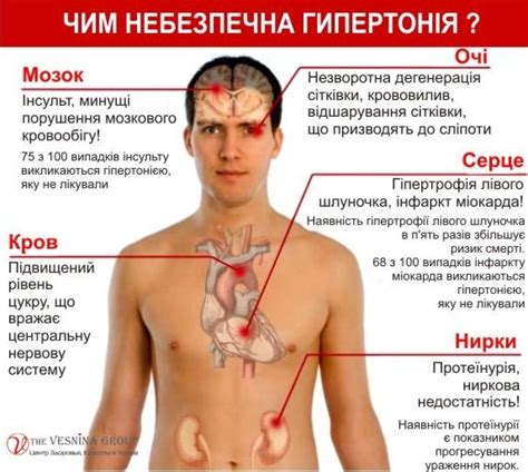 Що таке гіпертонічна хвороба? Консультація лікаря