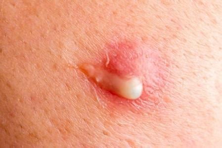 bisul gejala penyebab pengobatan  pencegahan