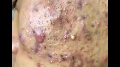 Unbelievable Blackhead Removal 2024: What Experts Are Saying About This Trend - rj33t6n