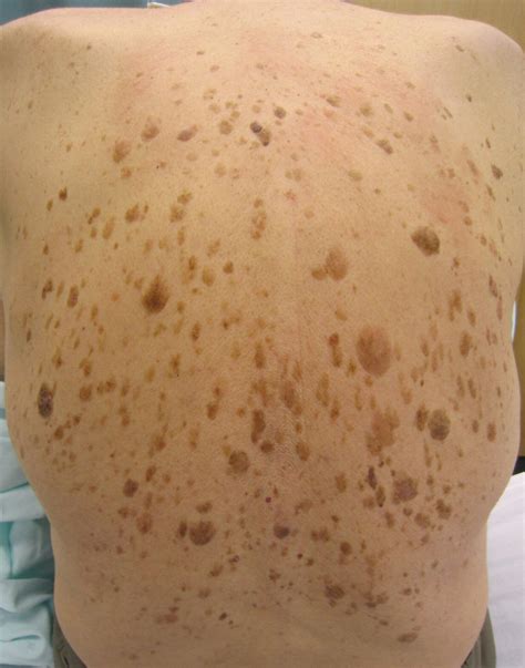 Removing Seborrheic Keratosis - VSM Pharmacy