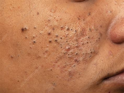 Acne vulgaris - Stock Image - C052/5435 - Science Photo Library