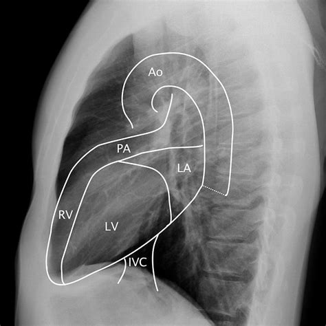 chest anatomy radiographs  ct  alexander baxter