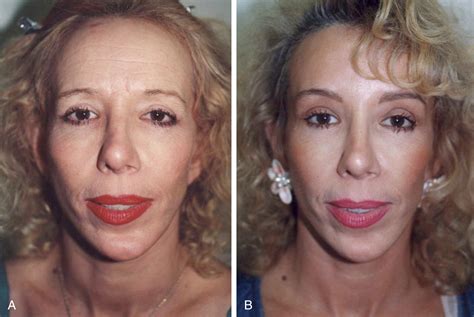 how to get rid of forehead creases 6