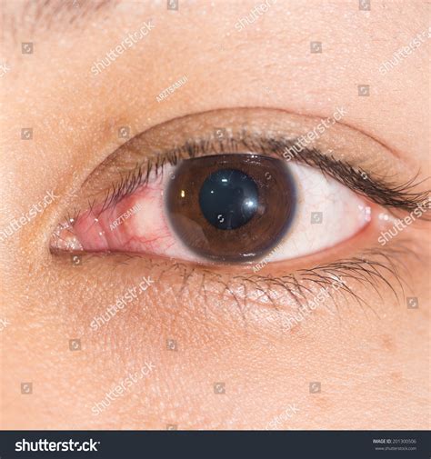 Close Episcleritis During Eye Examination Stock Photo 201300506