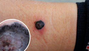 malignant melanoma step  health