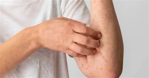 White Spots On Skin: Causes, Symptoms, And Treatment Options - CLEAR ...