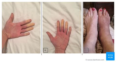 Raynaud’s syndrome: Signs, symptoms, causes & treatments | Kenhub