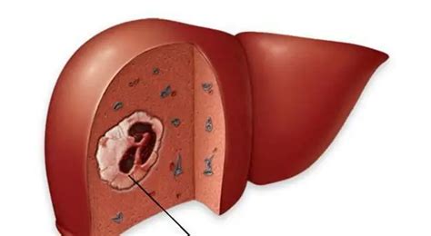 Hepatocellular carcinoma of the liver: diagnosis, symptoms and treatment | Health 2024