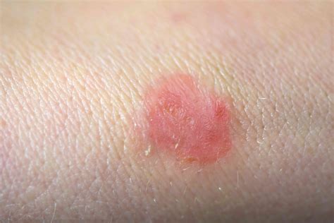 Ringworm: Types, Symptoms, Causes, Diagnosis, Treatment and More