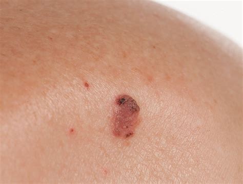 Squamous Cell Carcinoma | Skin Institute