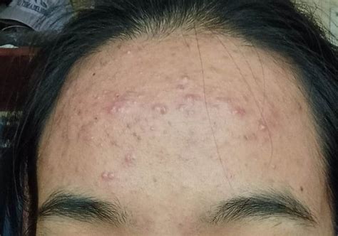 [Acne] [Routine Help] stubborn forehead acne : r/SkincareAddiction