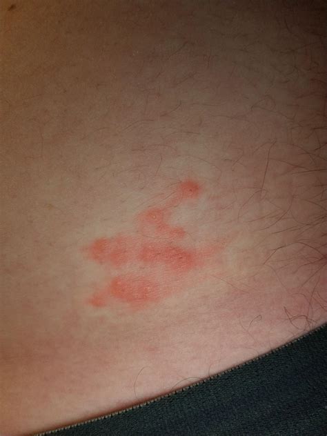 What Is Bumpy Rash at Claire Grissom blog