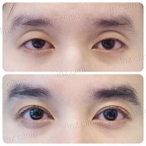 Current methods of double eyelid surgery, pros & cons - inZ Clinic