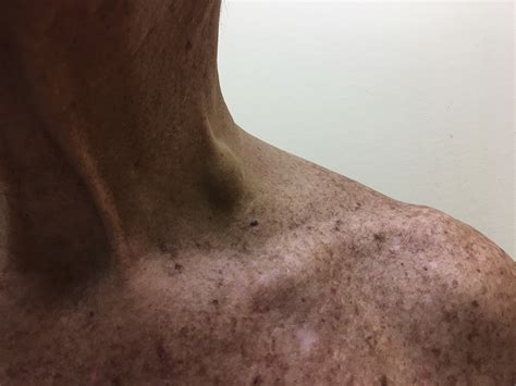 external jugular vein thrombosis secondary  deep tissue neck massage