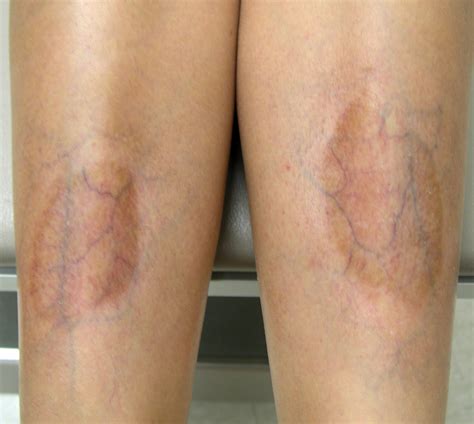 Leg Skin Discoloration Brown Spot
