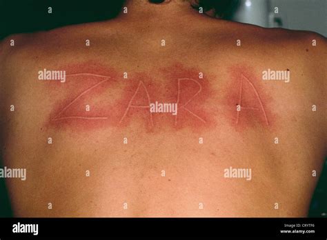 Dermographies hi-res stock photography and images - Alamy
