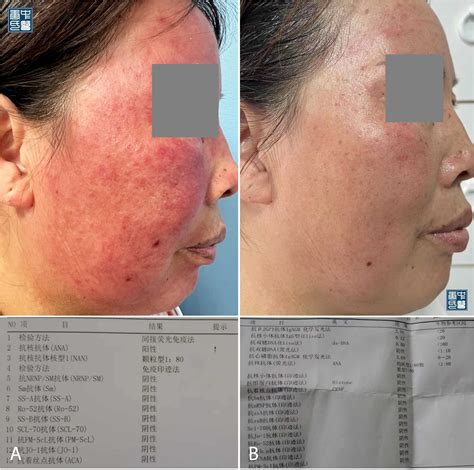 A Natural Journey to Remission: Confronting Acute Cutaneous Lupus ...