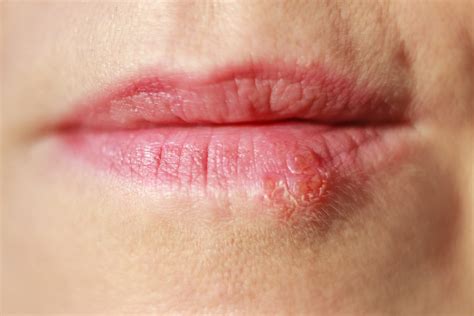 Aphthous Ulcers vs. Cold Sores - Ellis Family Dentistry
